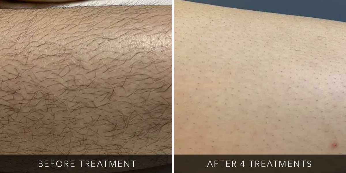 before-after-01